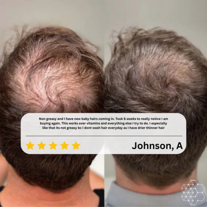 The HairRegen Roller